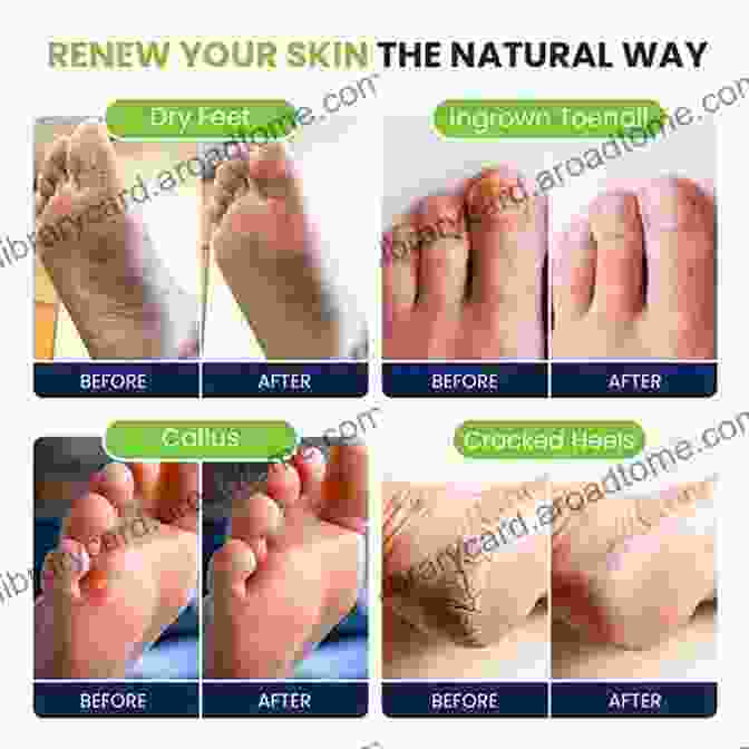 Epsom Salt For Athlete's Foot Tried And Tested Home Remedies To Treat Athlete S Foot