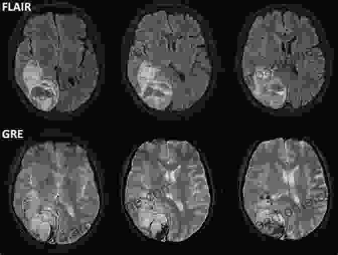 MRI Scan Of An Ischemic Stroke Magnetic Resonance Imaging In Ischemic Stroke (Medical Radiology)