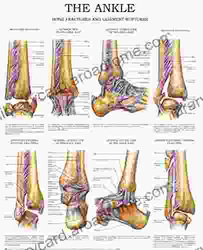 The ankle e chart: Bone fractures and ligament ruptures